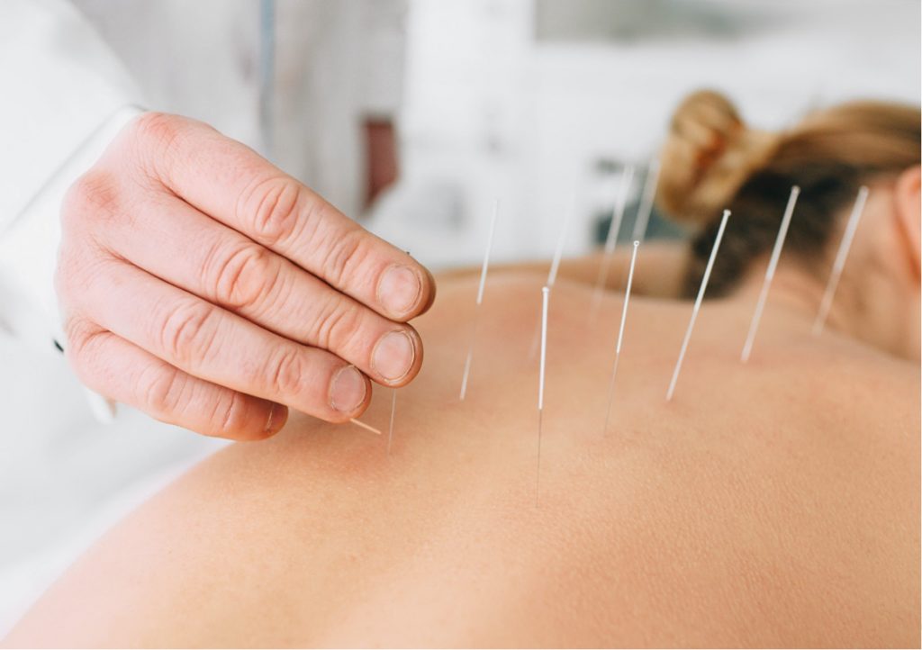 dry needling in back and neck